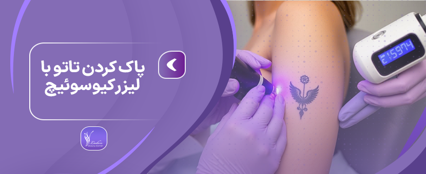 پاک کردن تاتو با لیزر کیوسوئیچ