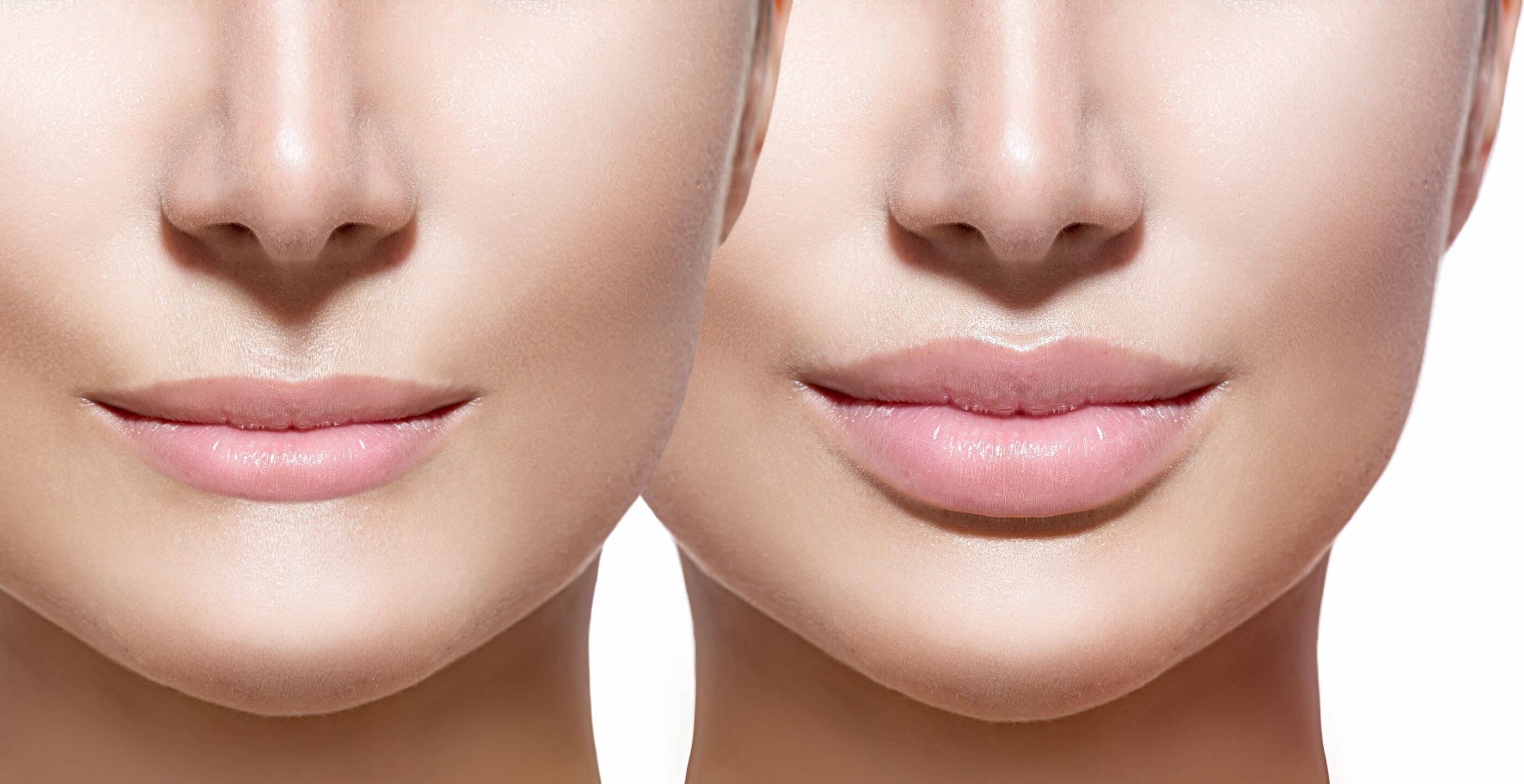 تزریق بوتاکس لب چیست؟(هزینه، مزایا و معایب)-مرکز زیبایی لادن